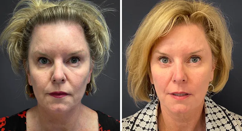 Before and after eyelid surgery: patient's eyes from the front