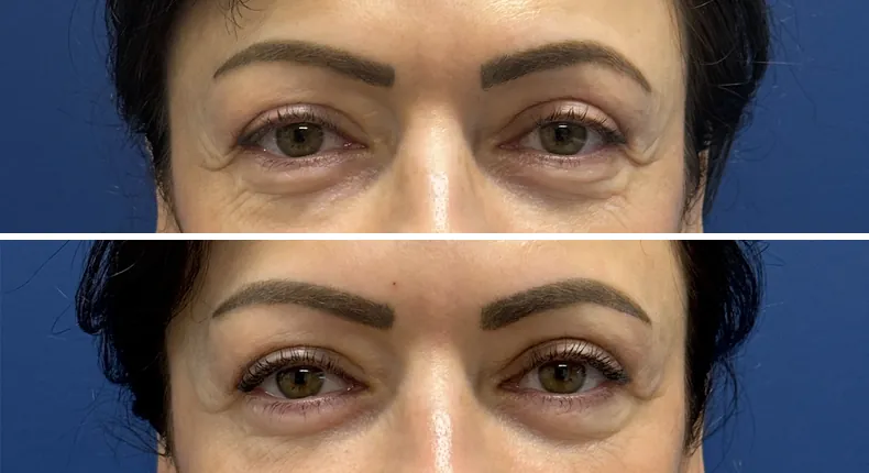 Before and after eyelid surgery: patient's eyes