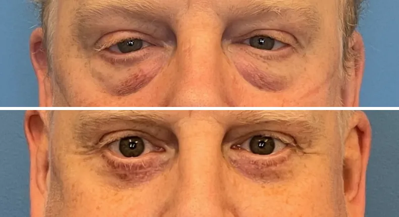 Before and after eyelid surgery: patient's eyes