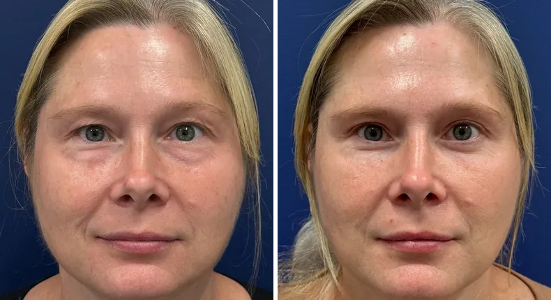 Before and after eyelid surgery: patient's eyes from the front