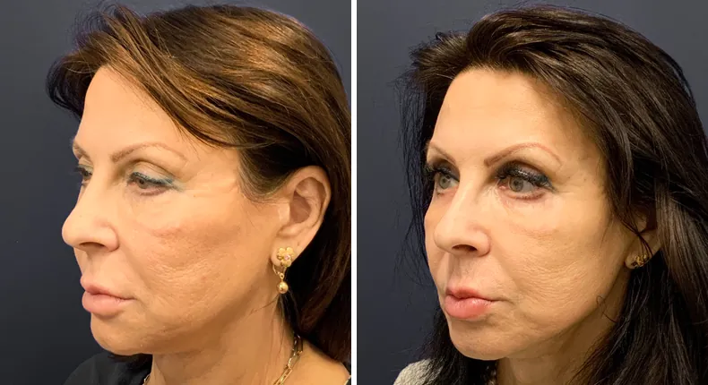 Before and after eyelid surgery: patient's eyes at a left angle