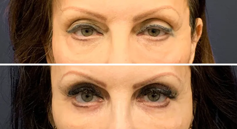 Before and after eyelid surgery: patient's eyes from the front