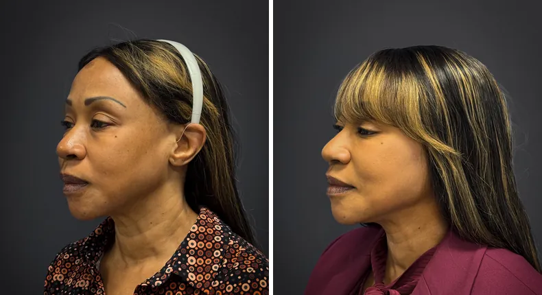 Before and after eyelid surgery: patient's eyes from the left side, with facelift