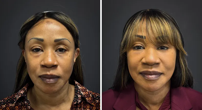 Before and after eyelid surgery: patient's eyes from the front, with facelift