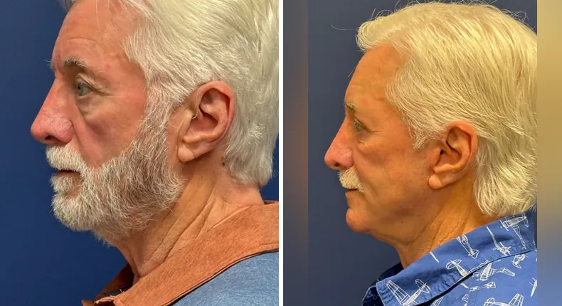Before and after eyelid surgery: patient's eyes from the left side, with Face360, facelift, facial fat grafting and neck lift