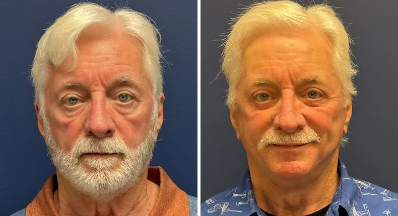 Before and after eyelid surgery: patient's eyes, with Face360, facelift, facial fat grafting and neck lift