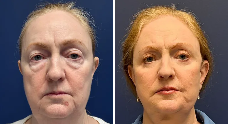 Before and after eyelid surgery: patient's eyes, with Face360, facelift, facial fat grafting and neck lift