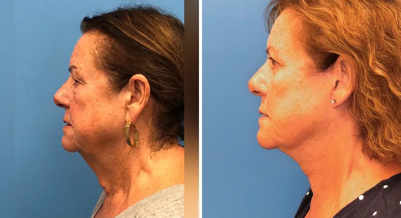 Before and after eyelid surgery: patient's eyes from the left side, with facelift and neck lift