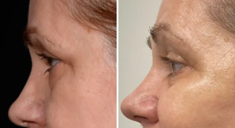 Before and after eyelid surgery: patient's eyes in left profile