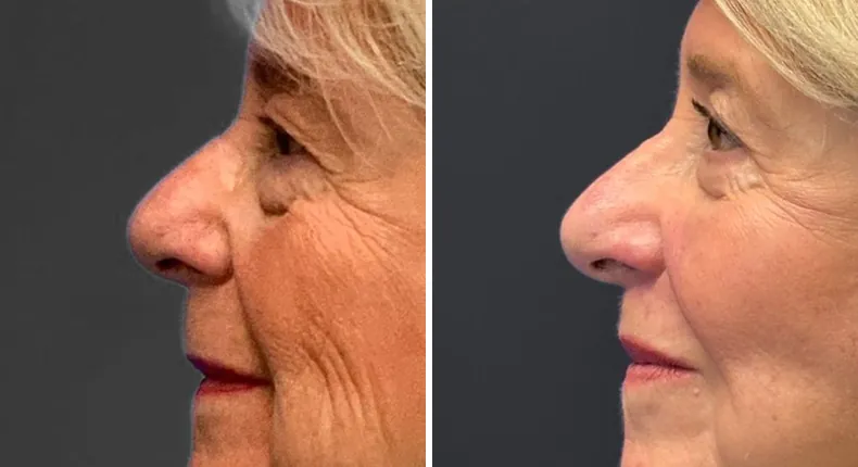 Before and after eyelid surgery: patient's eyes from the left side