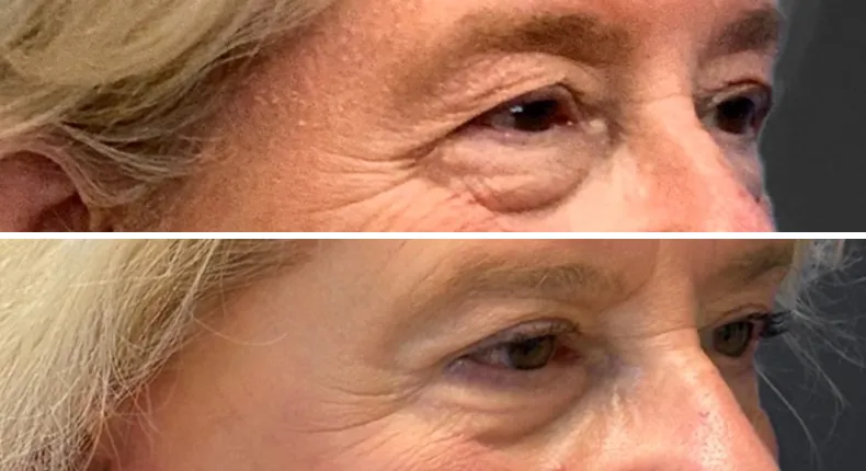 Before and after eyelid surgery: patient's eyes at a right angle