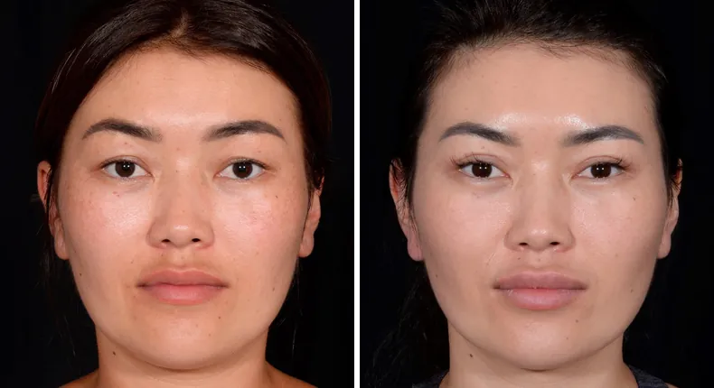 Before and after eyelid surgery: patient's eyes