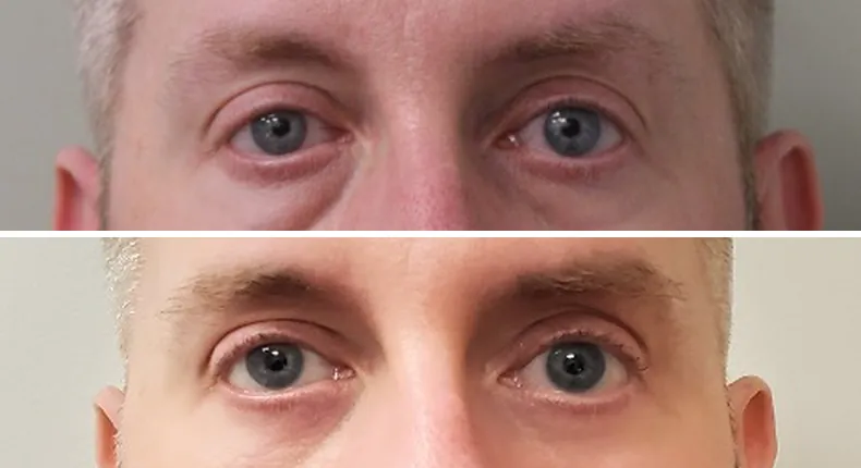 Before and after eyelid surgery: patient's eyes