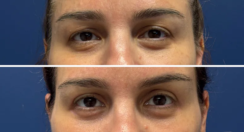 Before and after eyelid surgery: patient's eyes