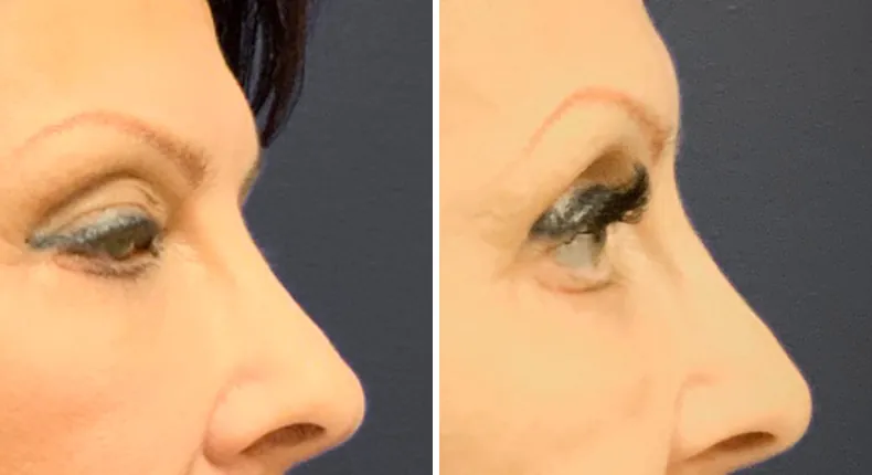 Before and after eyelid surgery: patient's eyes from the right side