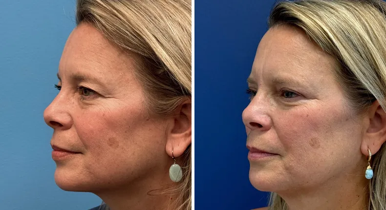 Before and after eyelid surgery: patient's eyes at a left angle