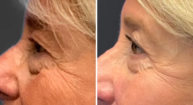 Before and after eyelid surgery: patient's eyes from the left side