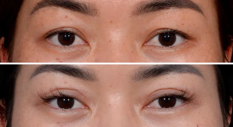 Before and after eyelid surgery: patient's eyes from the front