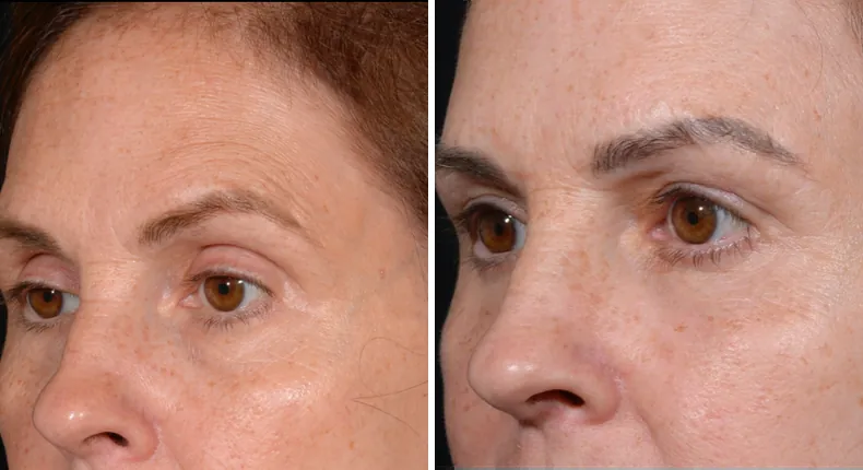 Before and after eyelid surgery: patient's eyes at a left angle