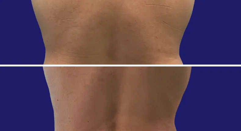 Before and after eyelid surgery: man's eyes, with liposuction