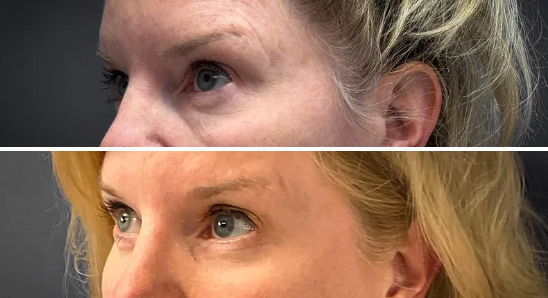 Before and after eyelid surgery: patient's eyes at a left angle