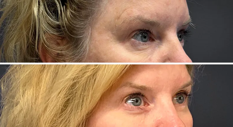 Before and after eyelid surgery: patient's eyes at a right angle