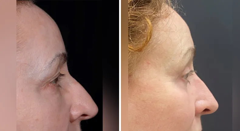Before and after eyelid surgery: patient's eyes in right profile