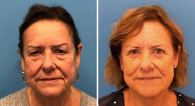 Before and after eyelid surgery: patient's eyes from the front, with facelift and neck lift