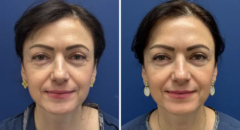 Before and after eyelid surgery: patient's eyes
