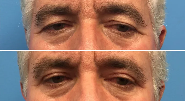 Before and after eyelid surgery: man's eyes