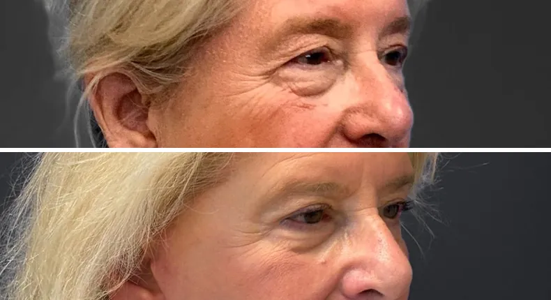 Before and after eyelid surgery: patient's eyes at a right angle