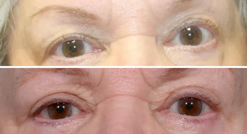 Before and after eyelid surgery: patient's eyes from the front
