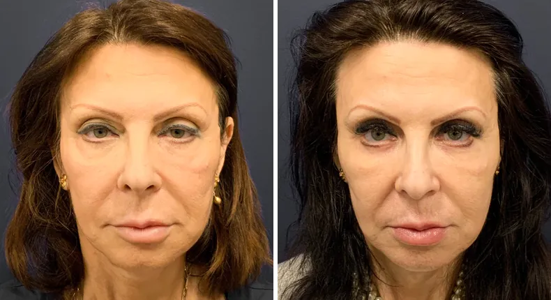 Before and after eyelid surgery: patient's eyes from the front