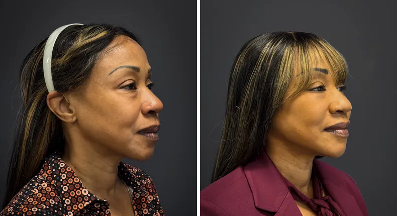 Before and after eyelid surgery: patient's eyes from the right side, with facelift