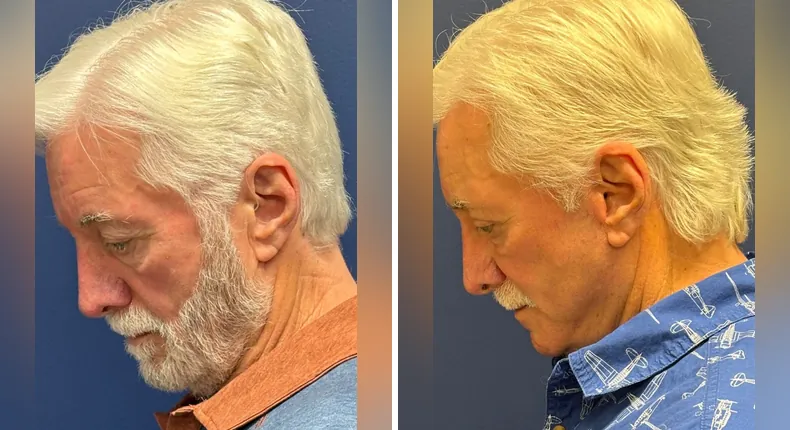 Before and after eyelid surgery: patient's eyes from the left side, with Face360, facelift, facial fat grafting and neck lift