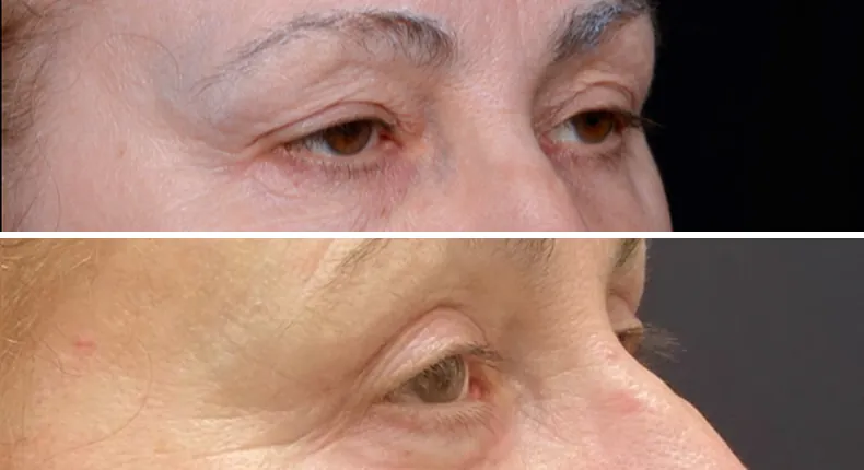 Before and after eyelid surgery: patient's eyes at a right angle