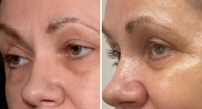 Before and after eyelid surgery: patient's eyes at a left angle