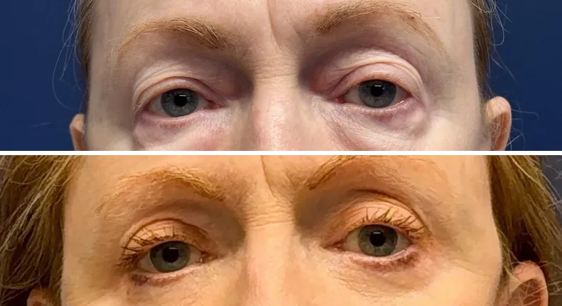Before and after eyelid surgery: patient's eyes