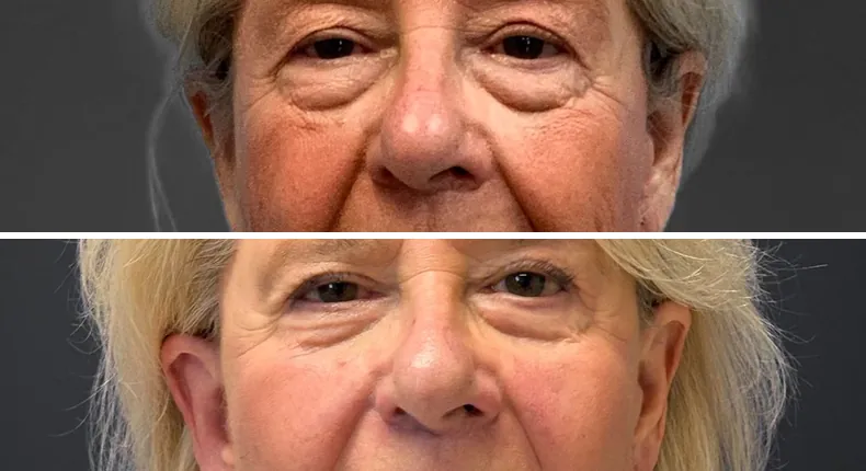 Before and after eyelid surgery: patient's eyes from the front