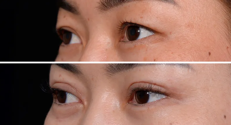 Before and after eyelid surgery: patient's eyes at a left angle