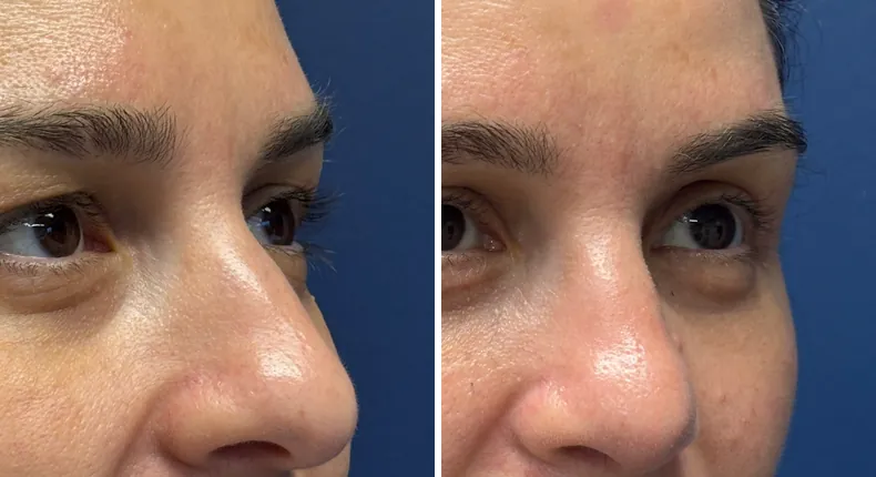 Before and after eyelid surgery: patient's eyes from the right side