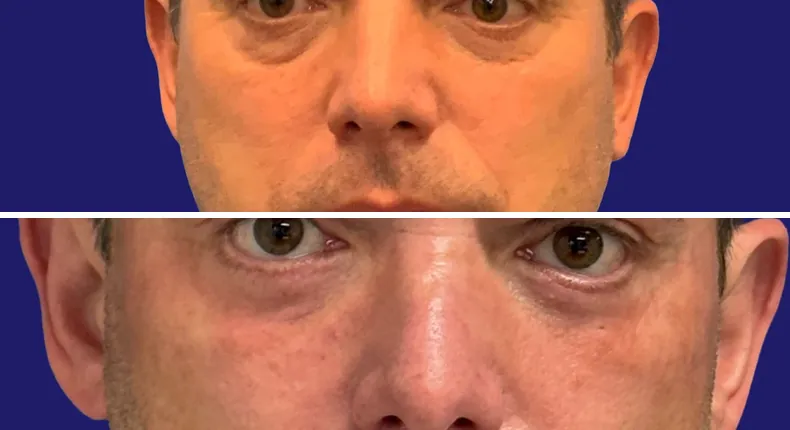 Before and after eyelid surgery: man's eyes, with liposuction