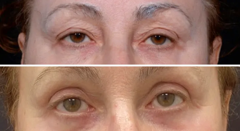 Before and after eyelid surgery: patient's eyes from the front