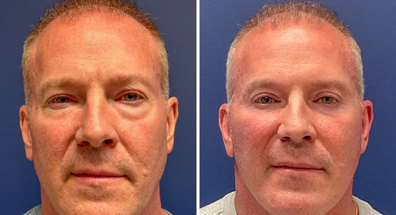 Before and after eyelid surgery: patient's eyes, with Face360, facelift and neck lift