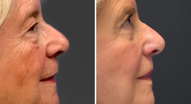 Before and after eyelid surgery: patient's eyes from the right side