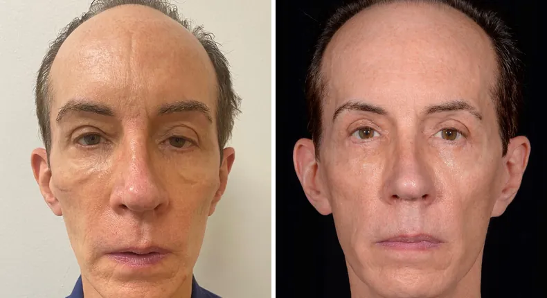 Before and after eyelid surgery: patient's eyes from the front