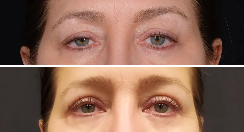 Before and after eyelid surgery: patient's eyes