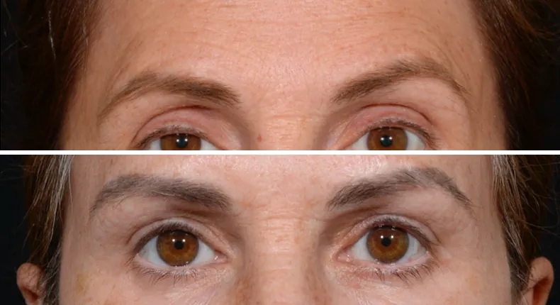 Before and after eyelid surgery: patient's eyes from the front