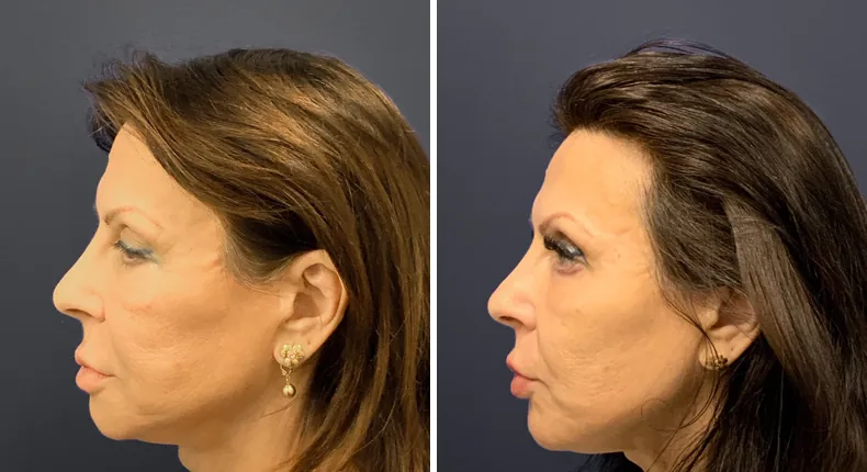 Before and after eyelid surgery: patient's eyes from the left side