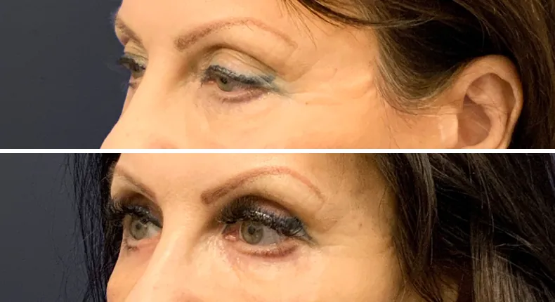 Before and after eyelid surgery: patient's eyes at a left angle